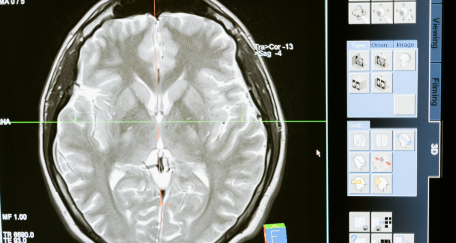 Neuroplasticidade: Como o Cérebro Pode se Reconfigurar em Qualquer Idade